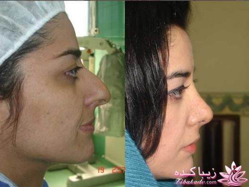 جراحی بینی - جراحی زیبایی